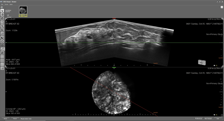 This is an ultrasound image of a female breast with a complex cysts. The top image displays the breast in an axial plane and the lower image displays the breast in the coronal plane.

The cystic structures are visible in the axial planes and exhibit posterior enhancement.  In addition the margin of the structure is slightly irregular and exhibits the accumulation of debris.   