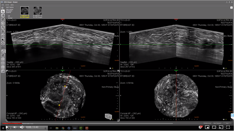 This is an image of a bilateral breast 3D Automated Breast Ultrasound (ABUS) exam of a female heterogeneously dense breast (BI-RADS C) .  Both the left an right breast are displayed are displayed on the monitors for rapid comparison.  The axial  and coronal slices of each breast are displayed.  The coronal image aids in determining the location of structures and the relative location of structures to one another.

The multi-planar reconstruction (MPR) enables the radiologist to view any structure from any perspective.  Thereby eliminating the need for call backs to obtain additional images from different perspectives.

The radiologist has the capability to window level, zoom-in zoom-out, pan, measure linearly, measure volumes, rotate 3D volume, rotate plane, adjust slice thickness, thin MIPS, synchronize review, compare studies for breast cancer therapeutic monitoring.

The SOFIA 3D Automated Breast ultrasound (ABUS) exam is capable of penetrating through Extremely Dense Breast Tissue (BI-RADS D) and   Heterogeneously Dense Breast Tissue (BI-RADS C) enabling visualization to the pectorals muscle.